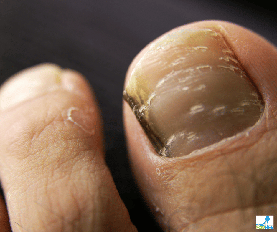 yellow, cracked toenail common in fungal infections on a hiker's foot yellow, cracked toenail common in fungal infections on a hiker's foot