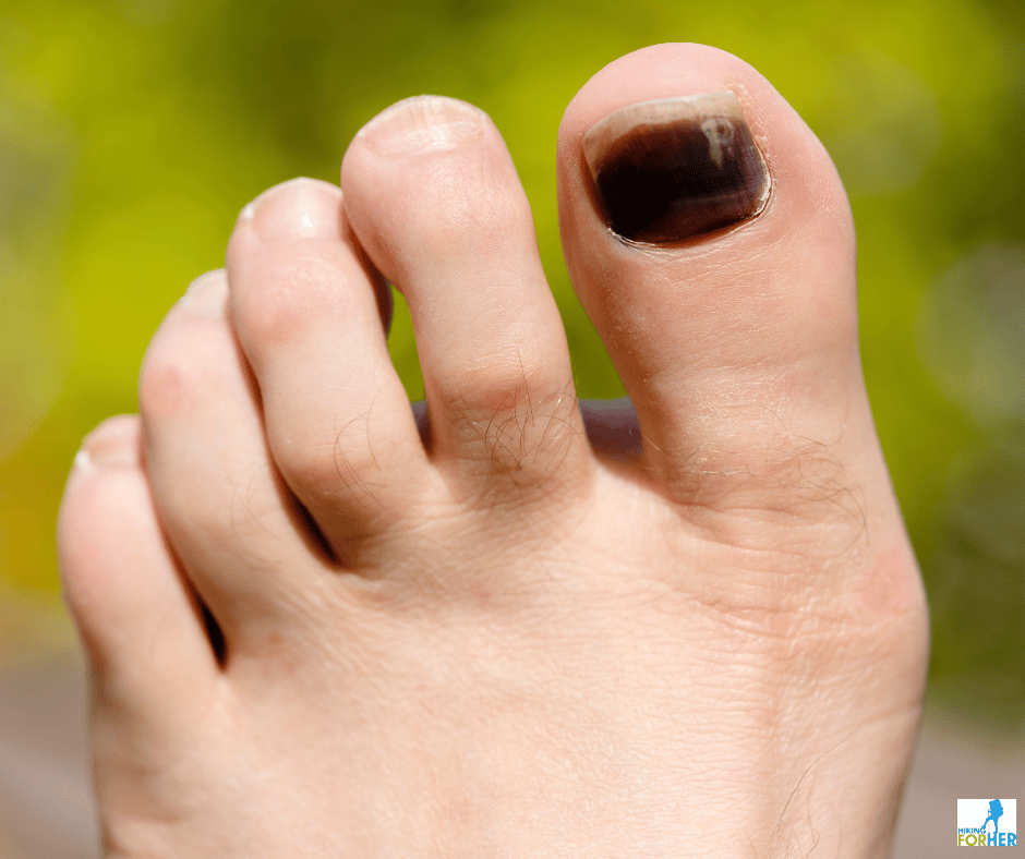 blackened toenail on big toe